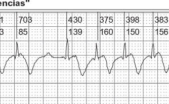 Paciente con marcapasos definitivo. ¿Cuál es la espiga, cuál el QRS y la onda T?