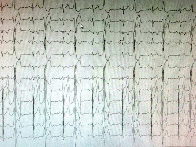 Paciente de 23 años sin cardiopatía estructural y normalización total del ECG luego de ARF