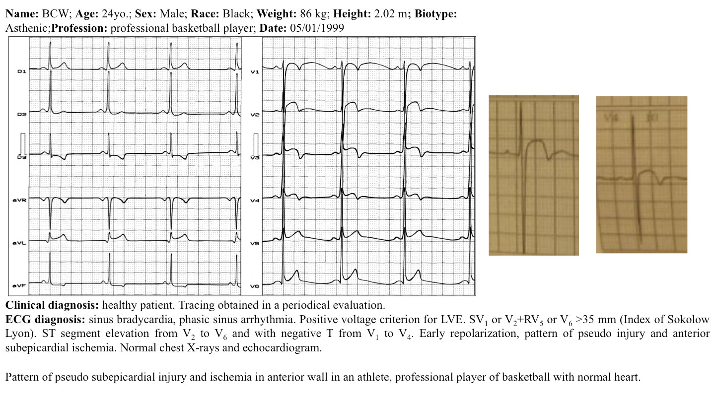 Pattern of pseudo subepicardial injury and ischemia in anterior wall in an athlete, professional player of basketball with normal heart