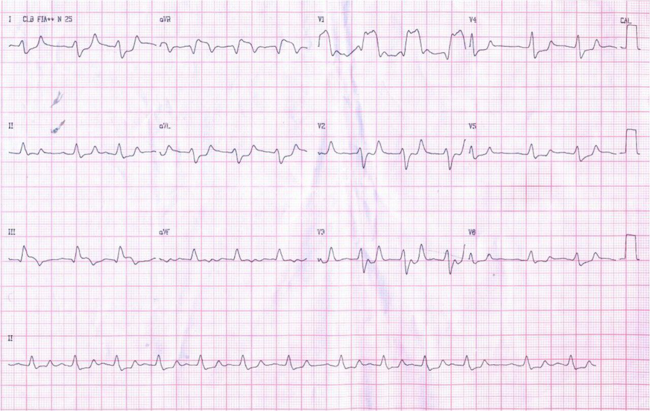 Hipertenso diabético con K = 7.9 cuyo ECG simula SCACEST; desaparece con gluconato de Ca