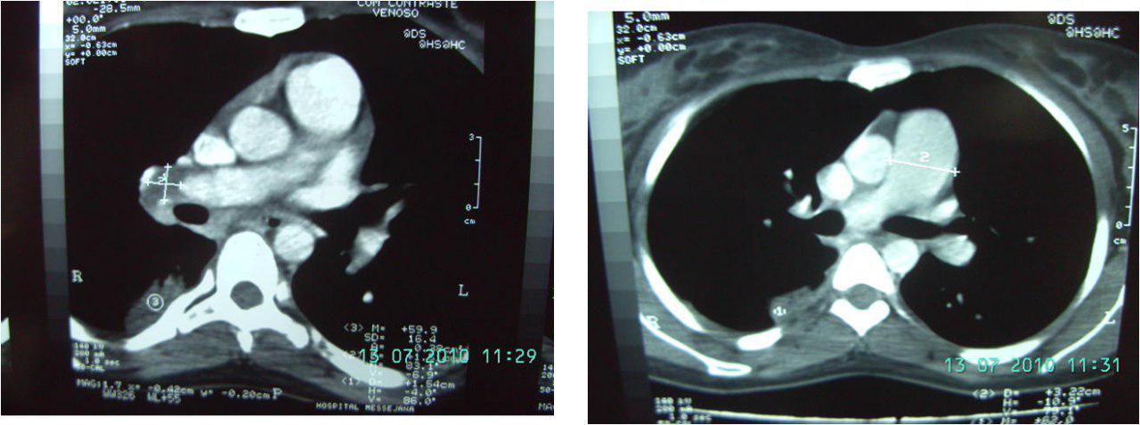 Femenina 20a con disnea progresiva por tromboembolismo pulmonar