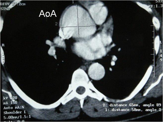 Masculino de 21 años con Síndrome de Marfan y aneurisma de aorta ascendente presenta disección después del primer reemplazo protésico