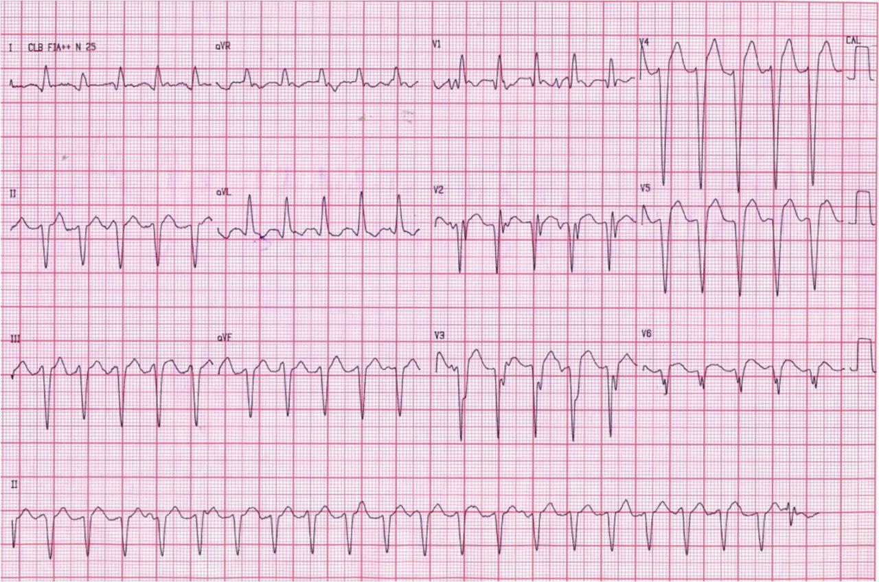 Taquicardia de QRS más estrecho que el presentado en ritmo sinusal
