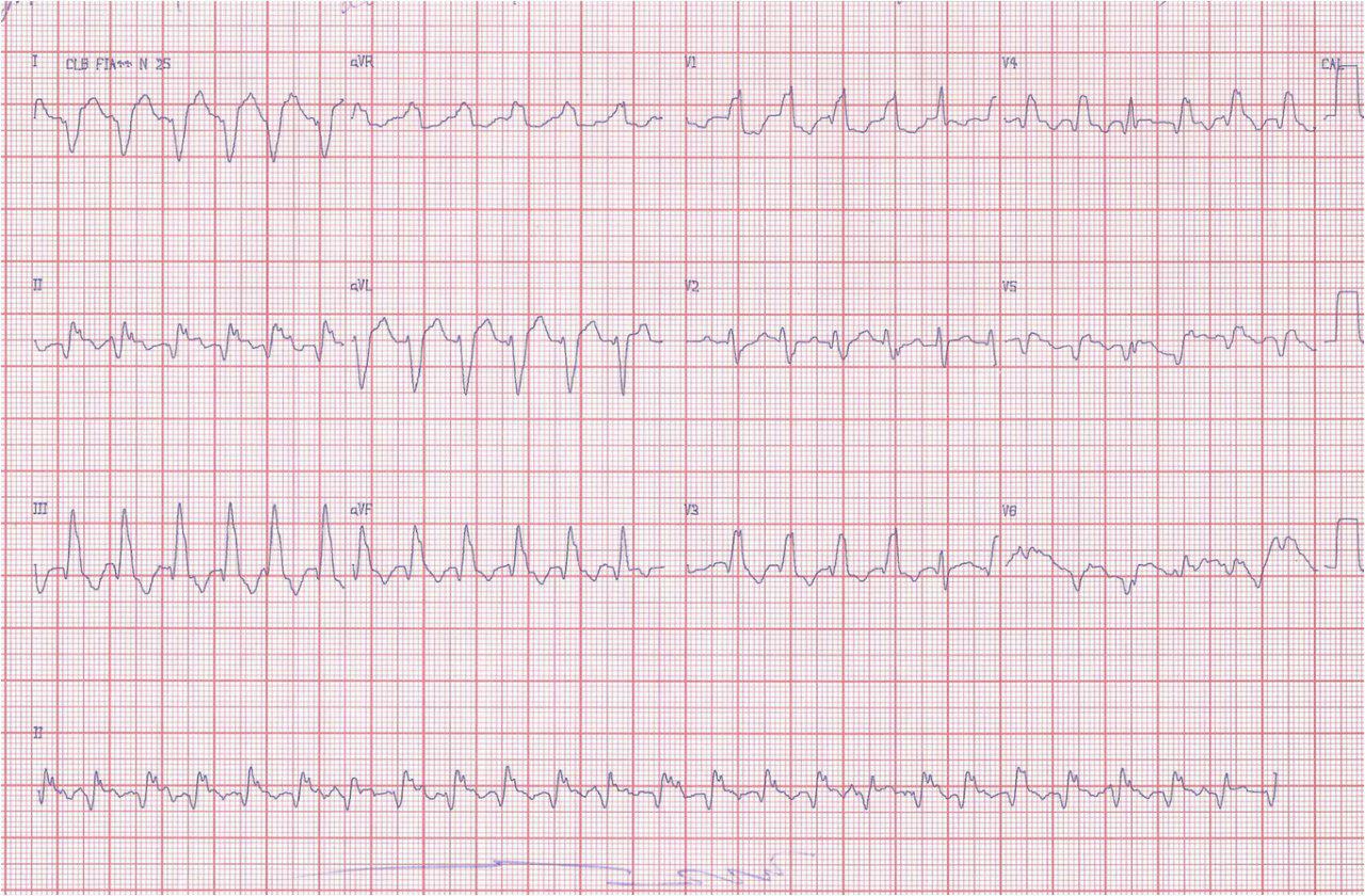 Paciente de 65 años con infarto previo y aneurisma ventricular. TVMS y reversión