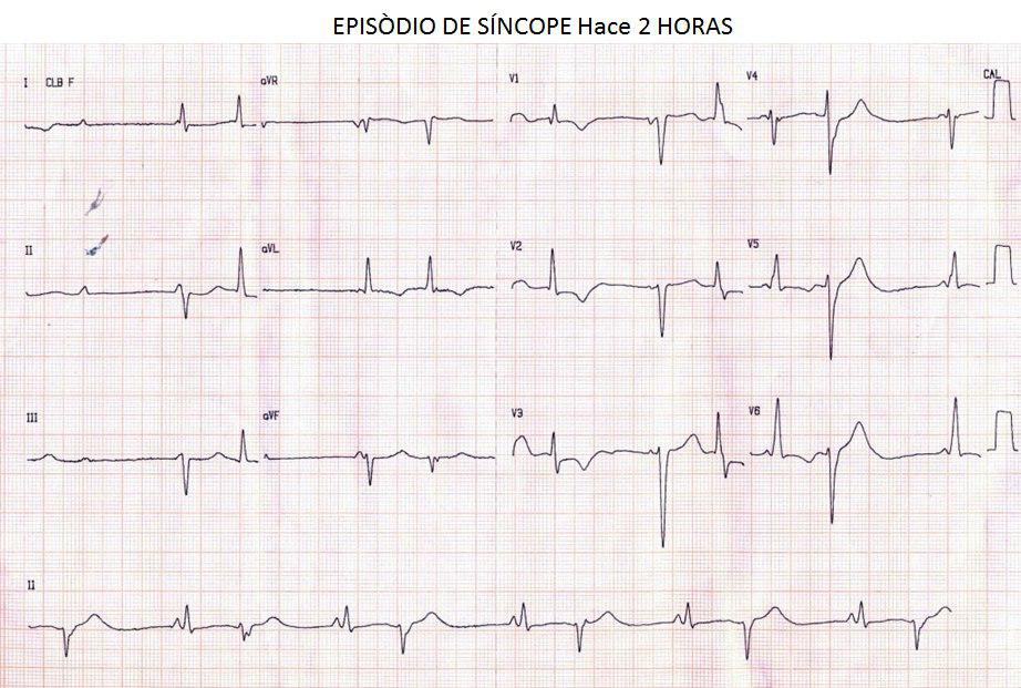 Episodio sincopal en paciente con BAVC y arritmia ventricular, que con marcapaseo continuo desarrolla QT largo y T negativas por memoria cardíaca