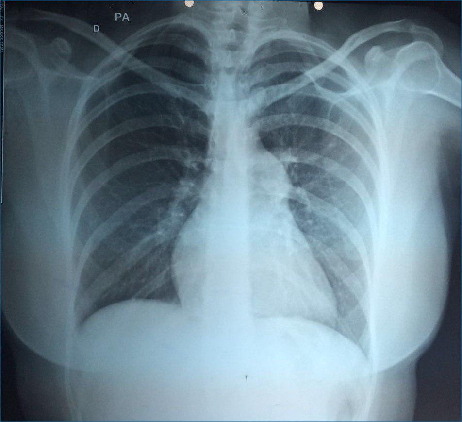 Mujer de 33 años portadora de soplo en foco pulmonar, con disnea y síncope por estenosis pulmonar severa