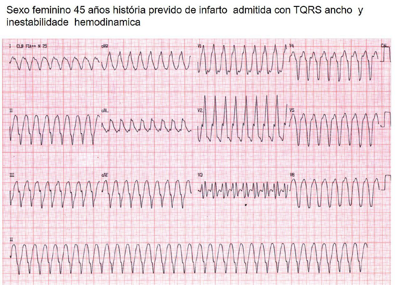 Taquicardia ventricular originada en aneurisma post infarto en mujer de 45 años