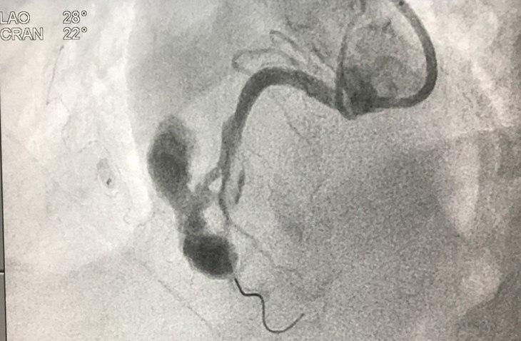 Perforación o ruptura de arteria CD durante procedimiento de angioplastia