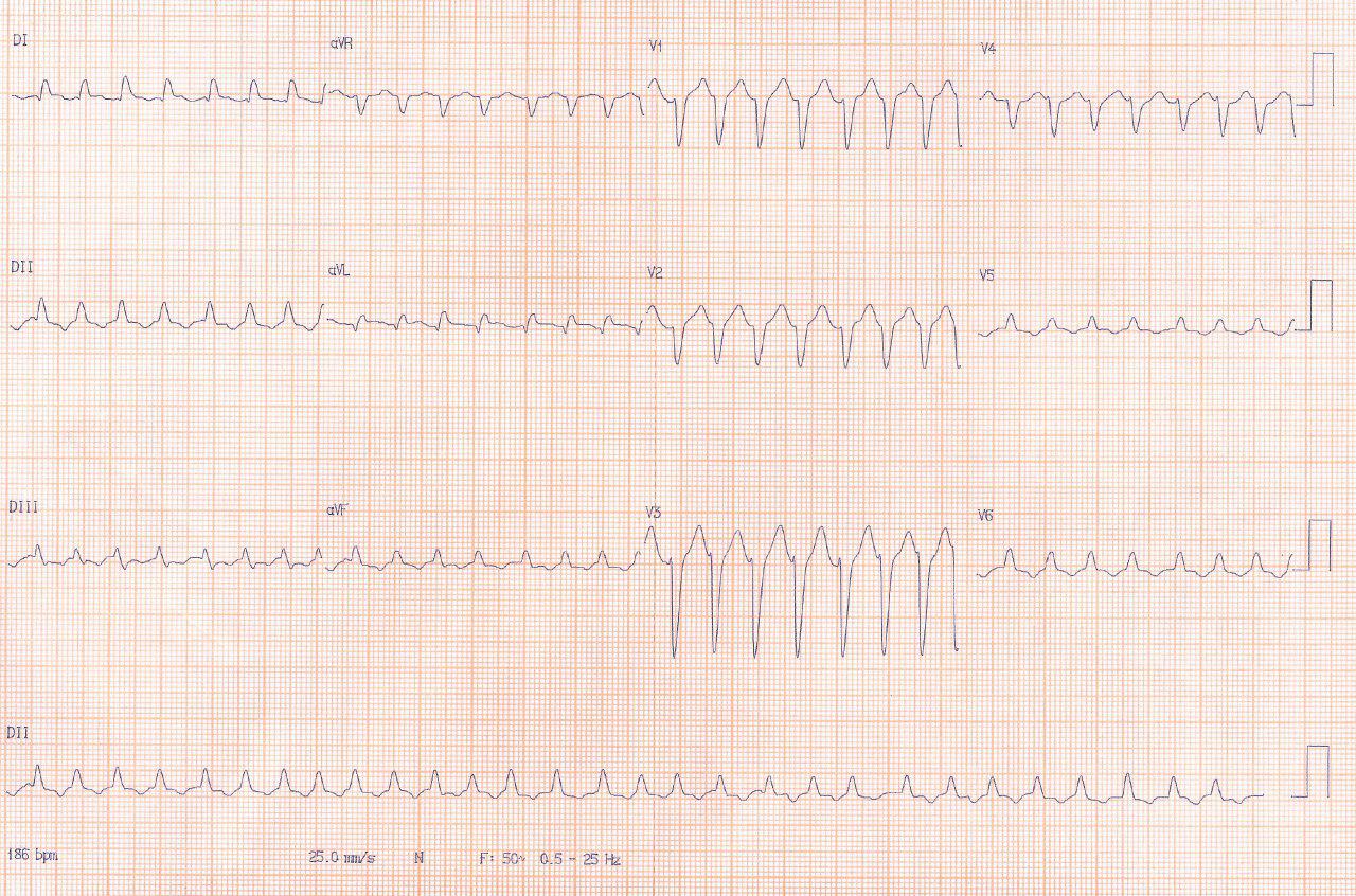 Paciente con infarto previo e implante de stent presenta taquicardia de QRS ancho con inestabilidad hemodinámica