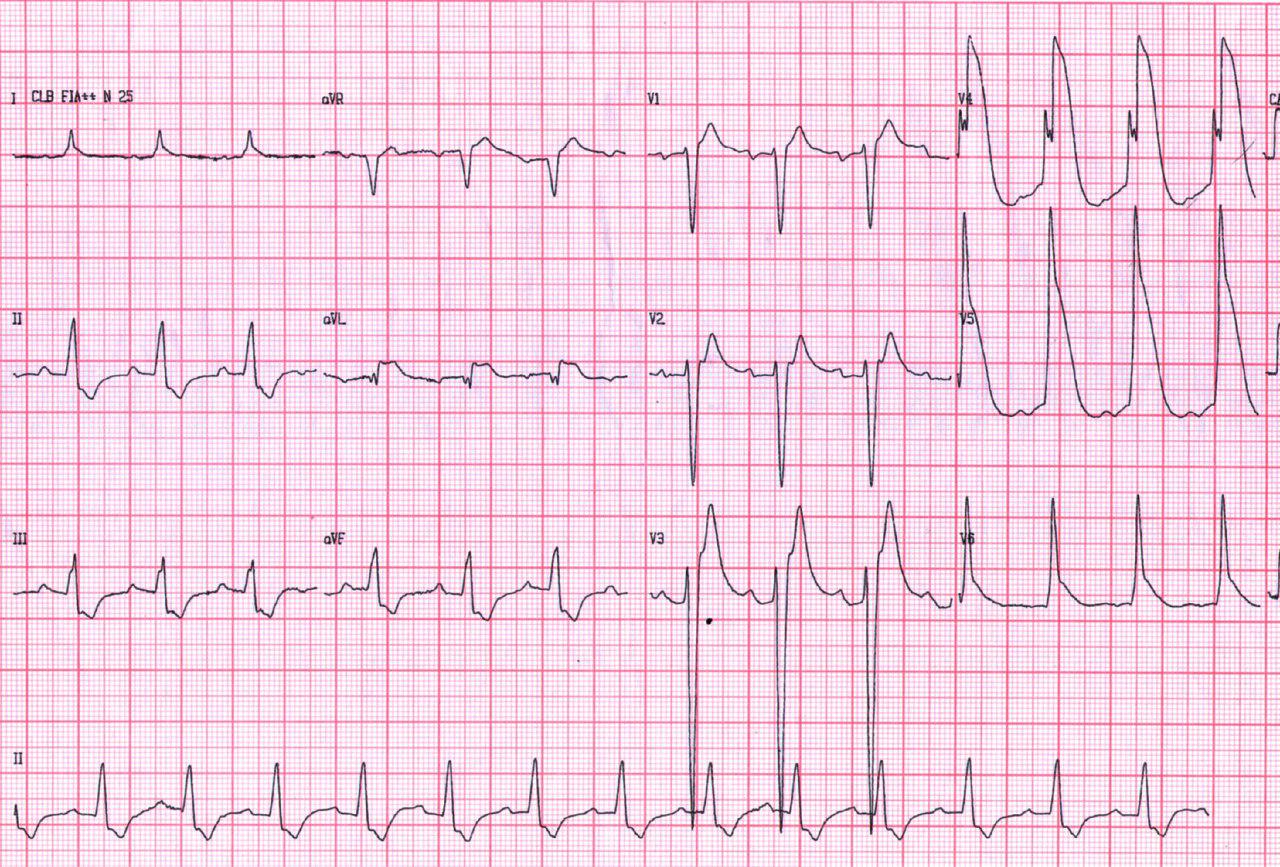 Masculino de 56 años portador de miocardiopatía dilatada no isquémica con antecedentes de síncope por FV que revierte con CVE