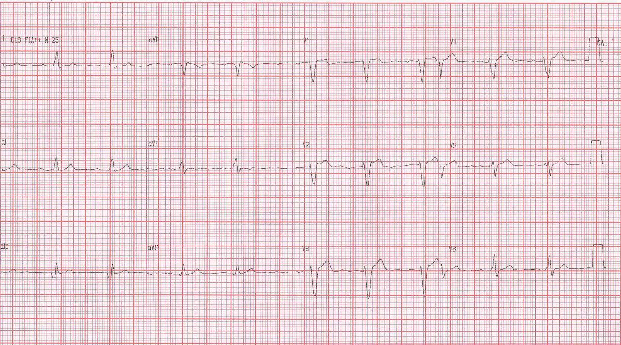 Paciente asintomático con antecedentes de paro cardíaco hace 3 años por Síndrome de Brugada tipo I