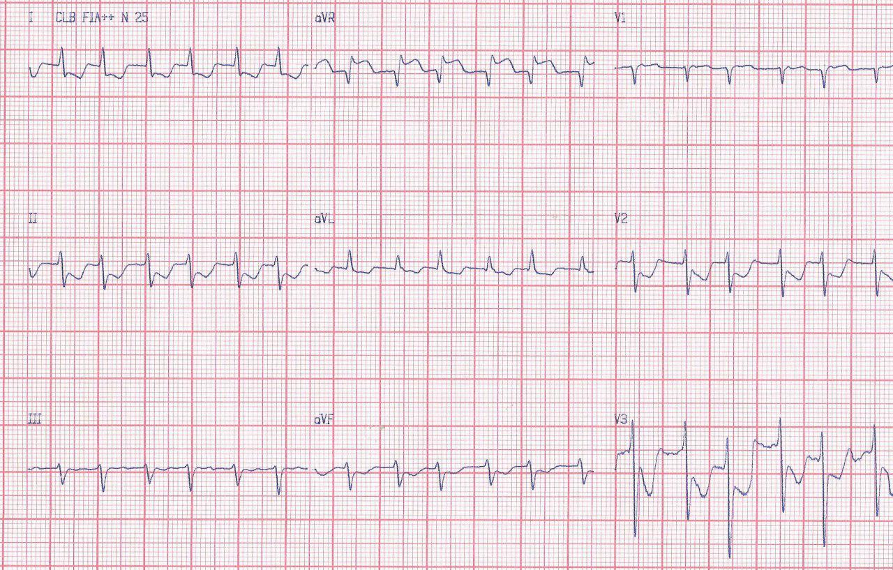 Taquicardia de QRS angosto que no responde al tratamiento por doble vía nodal