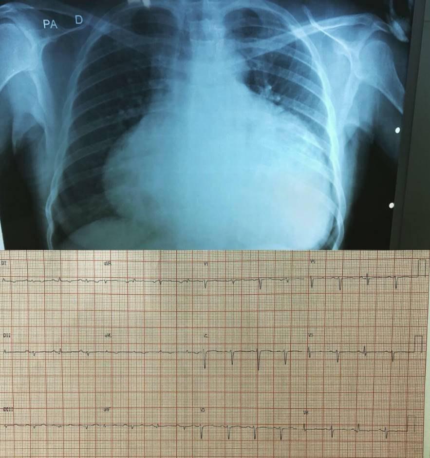 Paciente que presenta bajo voltaje en ECG y signos radiológicos de derrame pericárdico severo