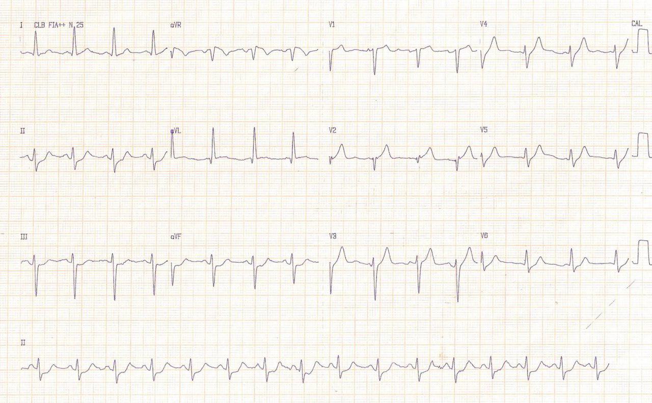 Hombre de 47 años con episodio de angor prolongado y paro cardíaco que presenta CCG normal y que durante IVUS desarrolla espasmo coronario
