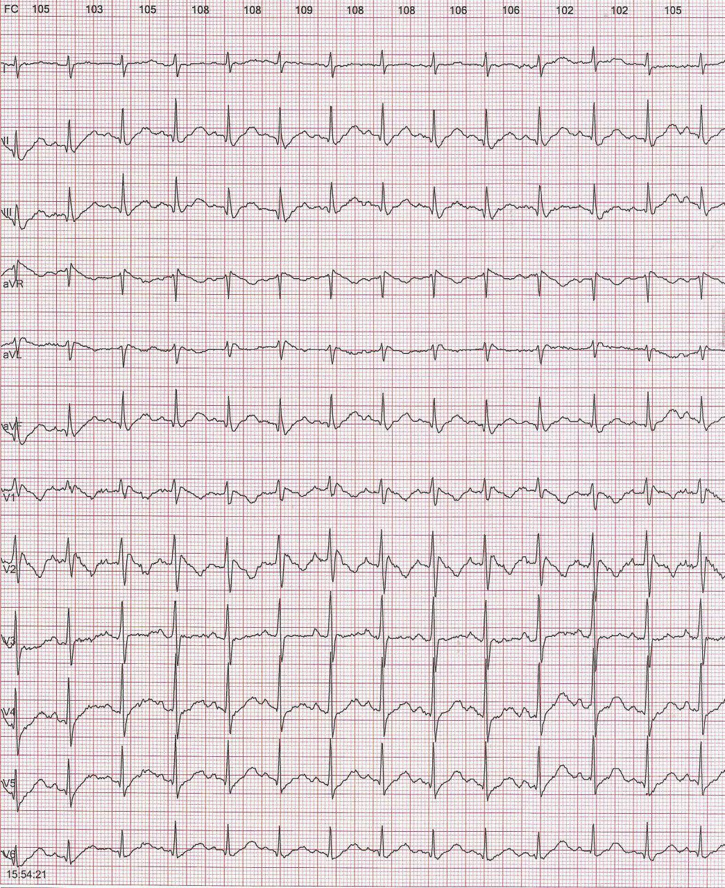 Mujer de 47 años sin cardiopatía estructural con palpitaciones nocturnas en la que se detecta patrón de Brugada tipo I durante ECG de Holter