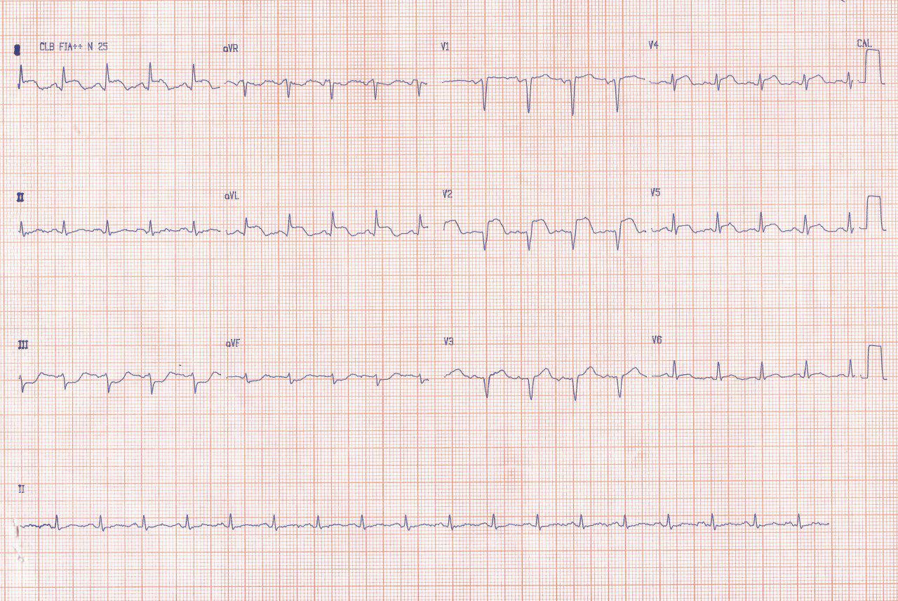 ECG de paciente con SCA con elevación de ST en DI y aVL sin depresión evidente en V1-V2, típico de oclusión de arteria Cx