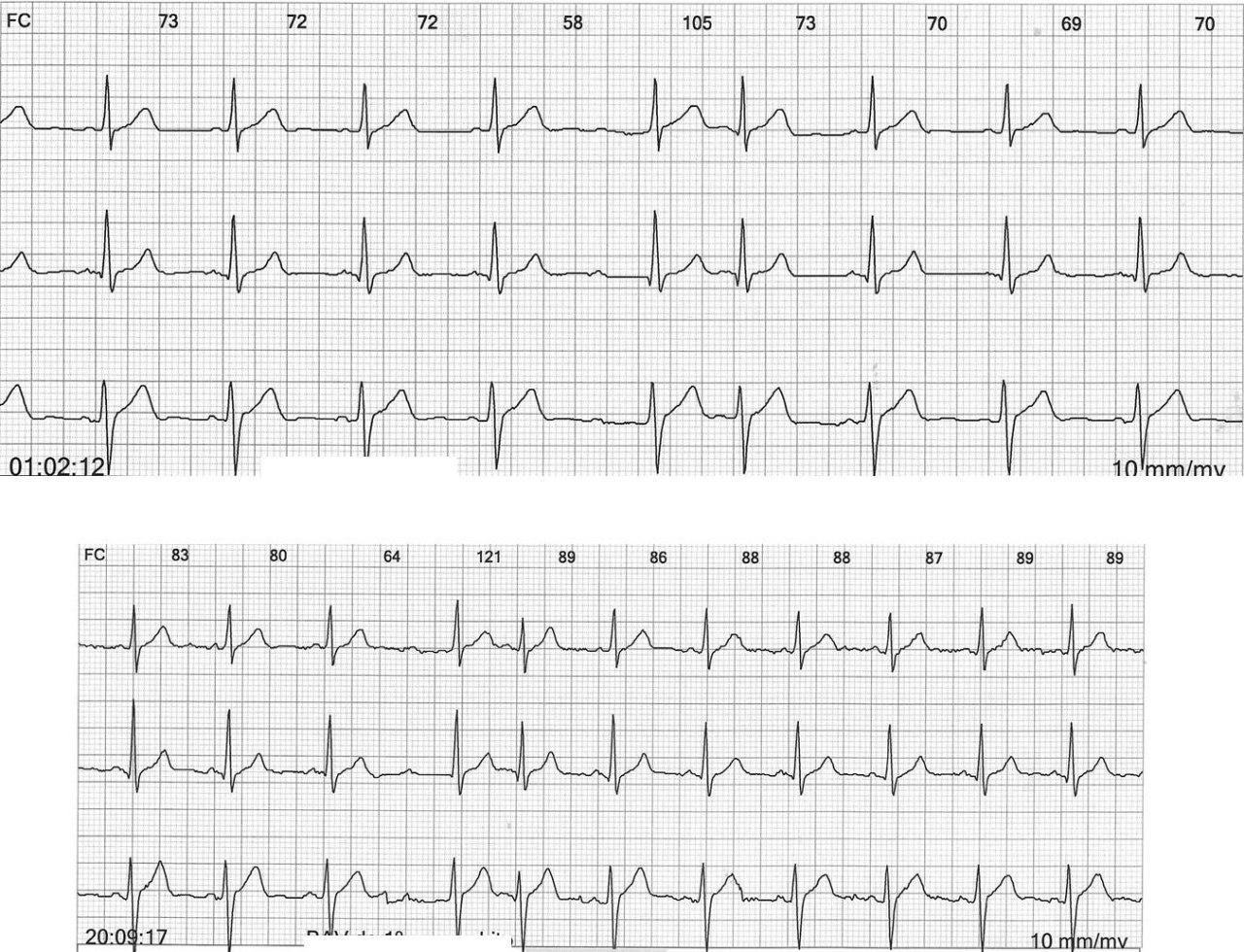 Paciente masculino de 56 años sin cardiopatía estructural que presenta extrasísitoles hisianas ocultas en el ECG de Holter