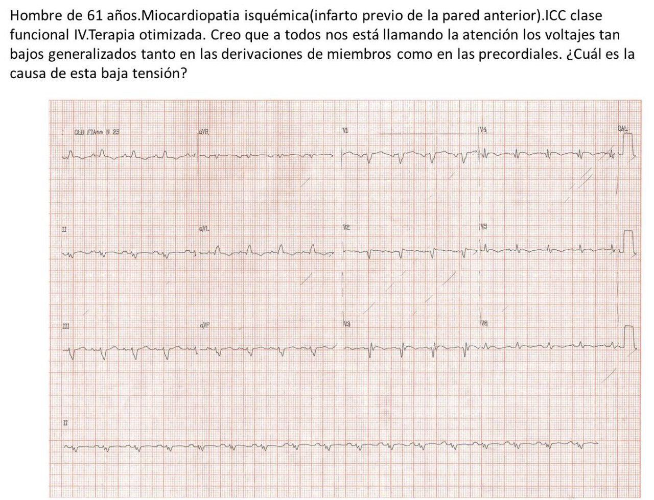 Paciente masculino de 61 años portador de severa miocardiopatía dilatada isquémico – necrótica secundaria a múltiples infartos previos