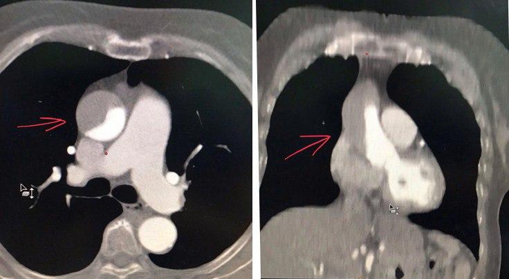 Mujer de 73 años con angina estable que es enviada a CCG durante la cuál se complica con disección iatrogénica de aorta ascendente con formación de trombo intramural