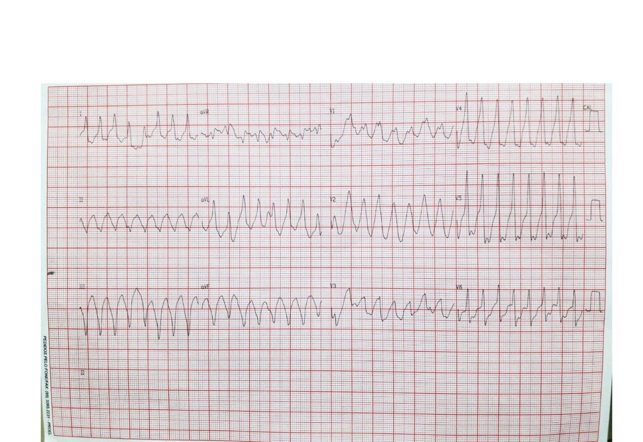Paciente con antecedentes de infarto previo y cirugía de by pass aorto coronario que presenta palpitaciones acompañadas de signos vagales por presentar TV