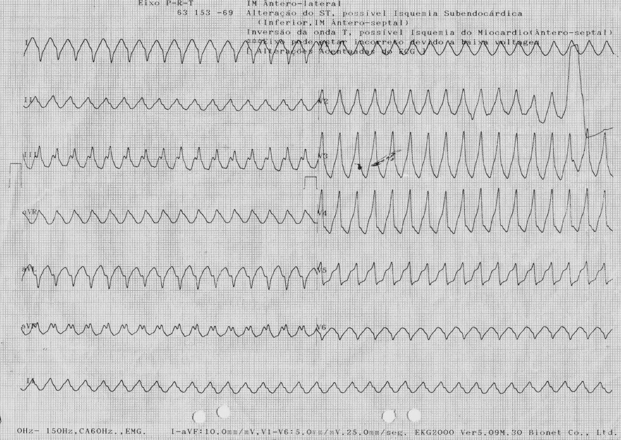 Paciente de 79 años que presenta taquicardia de QRS ancho la cuál se interpreta como TV aplicando los algoritmoas de Vereckei y de Brugada