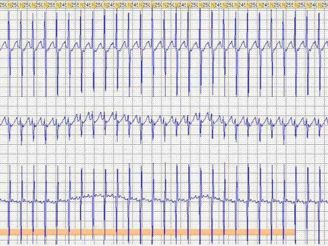 Trazado de paciente del que se carece de datos clínicos que presenta taquicardia de QRS angosto originada en la presencia de un Wolf Parkinson White