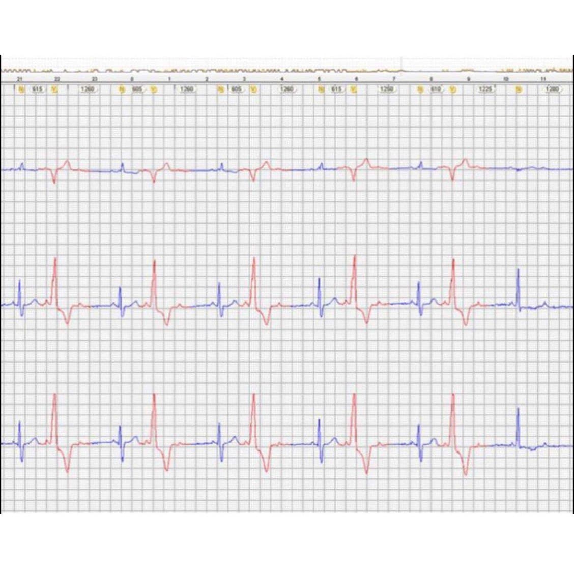 Trazado de Holter que muestra BAV 3:2 y desarrollo de taquicardia con Bloqueo en fase 3 por probable bloqueo infrahisiano