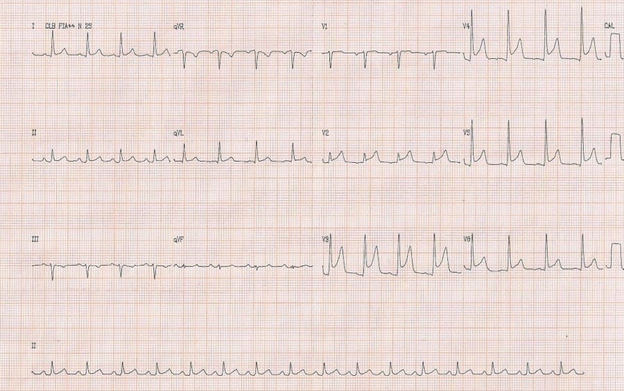 Varón de 47 años, hipertenso y fumador que presenta palpitaciones, con arterias coronarias angiográficamente normales y cuyo ECG muestra un patrón de repolarizaxción precoz