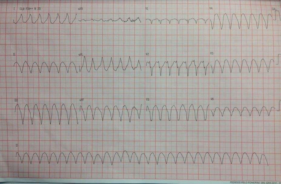 Paciente de 40 años portador de miocardiopatía chagásica que acude a emergencias por presentar taquicardia de QRS ancho correspondiente a una TV de origen apical