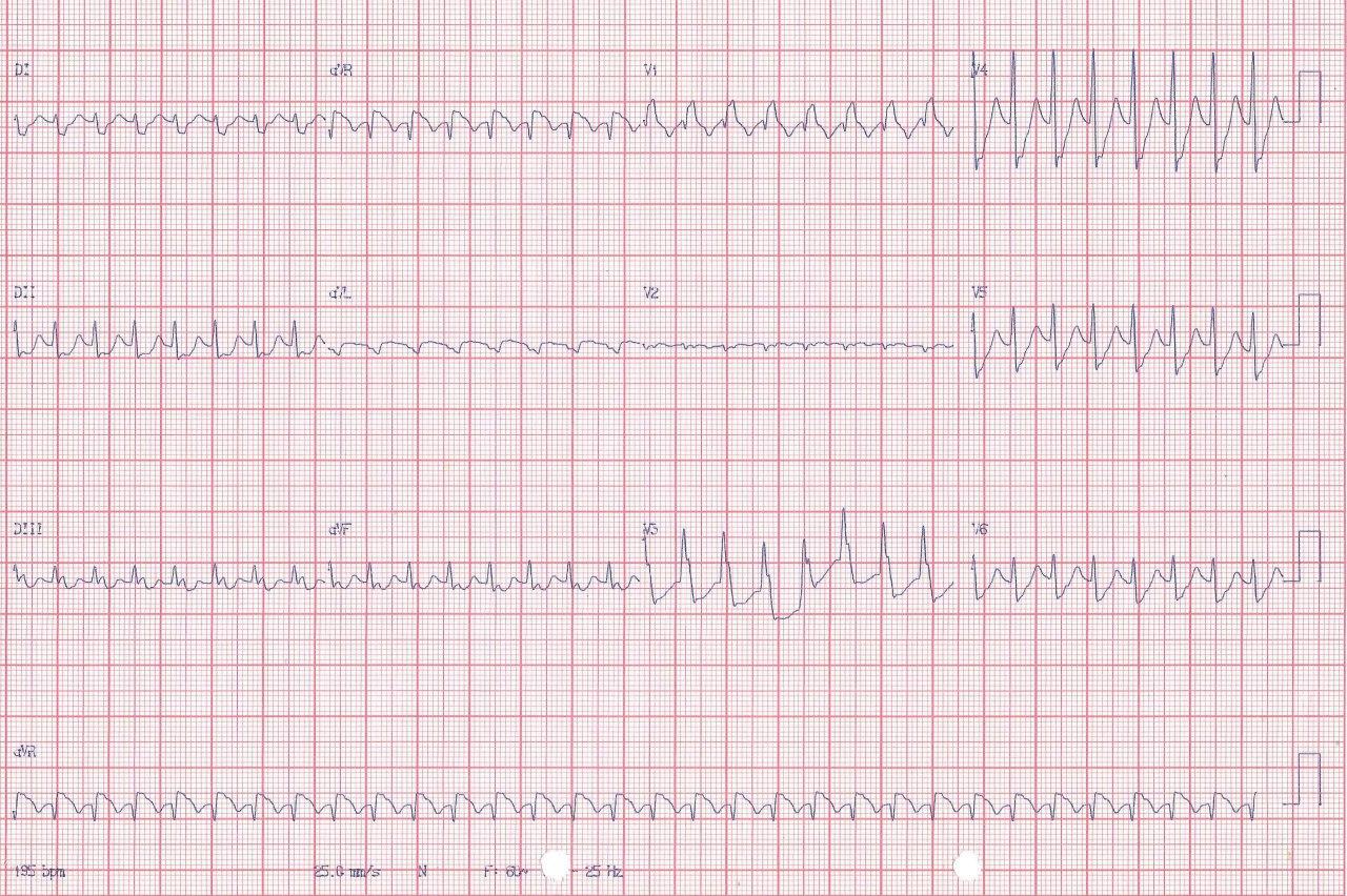 Trazado correspondiente a paciente hipertenso de 57 años con taquicardia regular con QRS ancho con ST elevado en AVR durante la taquicardia que sugiere TRAVO