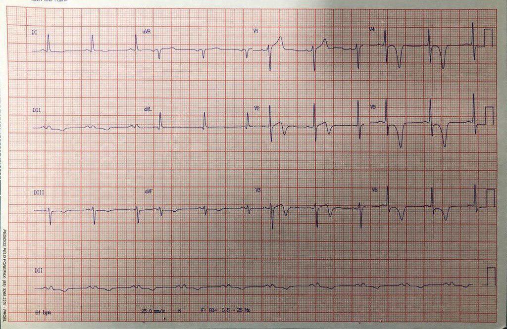 Hombre de 57 años que refiere dolor precordial cuyo ECG muestra ondas T típicas de miocardiopatía hipertrófica apical en alas de gaviota con CCG normal y confirmación ecocardiográfica