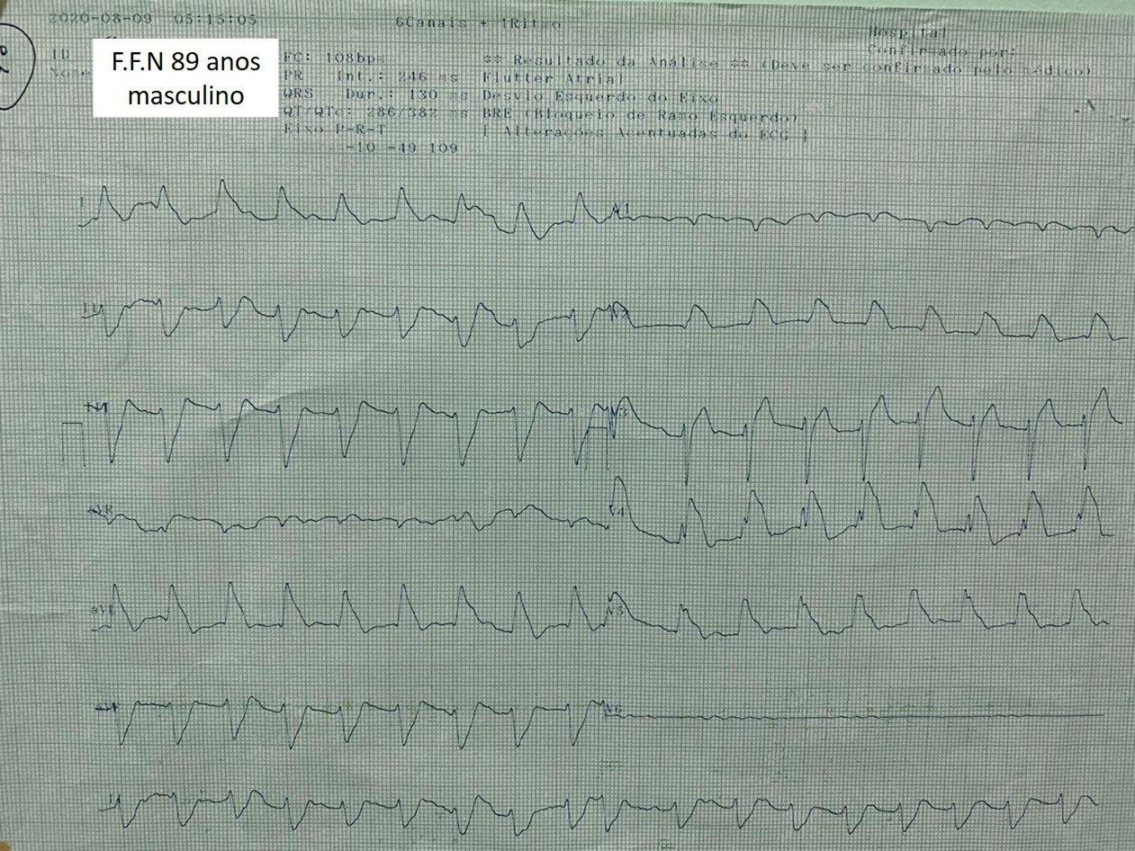 Paciente masculino de 89 años que presenta ángor y disnea que ingresa en shock cardiogénico constatándose en el ECG presencia de FA y ondas lambda por compromiso de TCI, aspirándose trombo + stent + 2b3a, que igualmente evoluciona al óbito