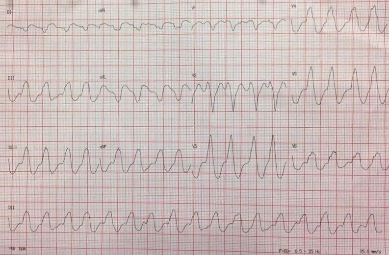 Paciente masculino con miocardiopatía dilatada chagásica que presenta TV epicárdica
