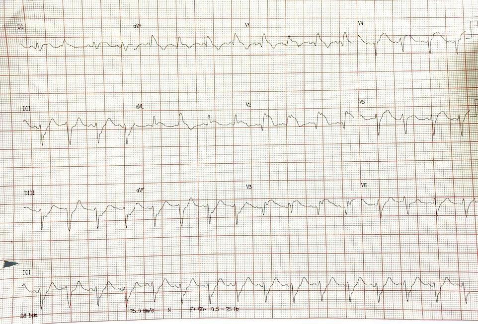 ECG de paciente con ángor que desarrolló shock cardiogénico refractario a pesar de la intervención coronaria percutánea por obstrucción de la DA total, suboclusión de CX y trombo en TCI