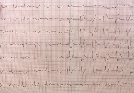 Paciente masculino de 49 años que presenta episodio de ángor y paro cardíaco del cuál es reanimado cuyo ECG posterior muestra ondas lambda por lesión de TCI