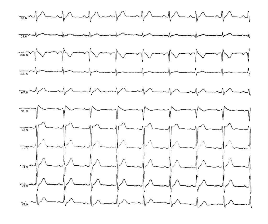 Paciente de 30 años que presenta episodio sincopal luego de ingesta alcohólica cuyo ECG muestra un patrón Brugada tipo I con onda R> 0,3 mV en aVR y onda S> 1,0 mV en D1, signos de mal pronóstico