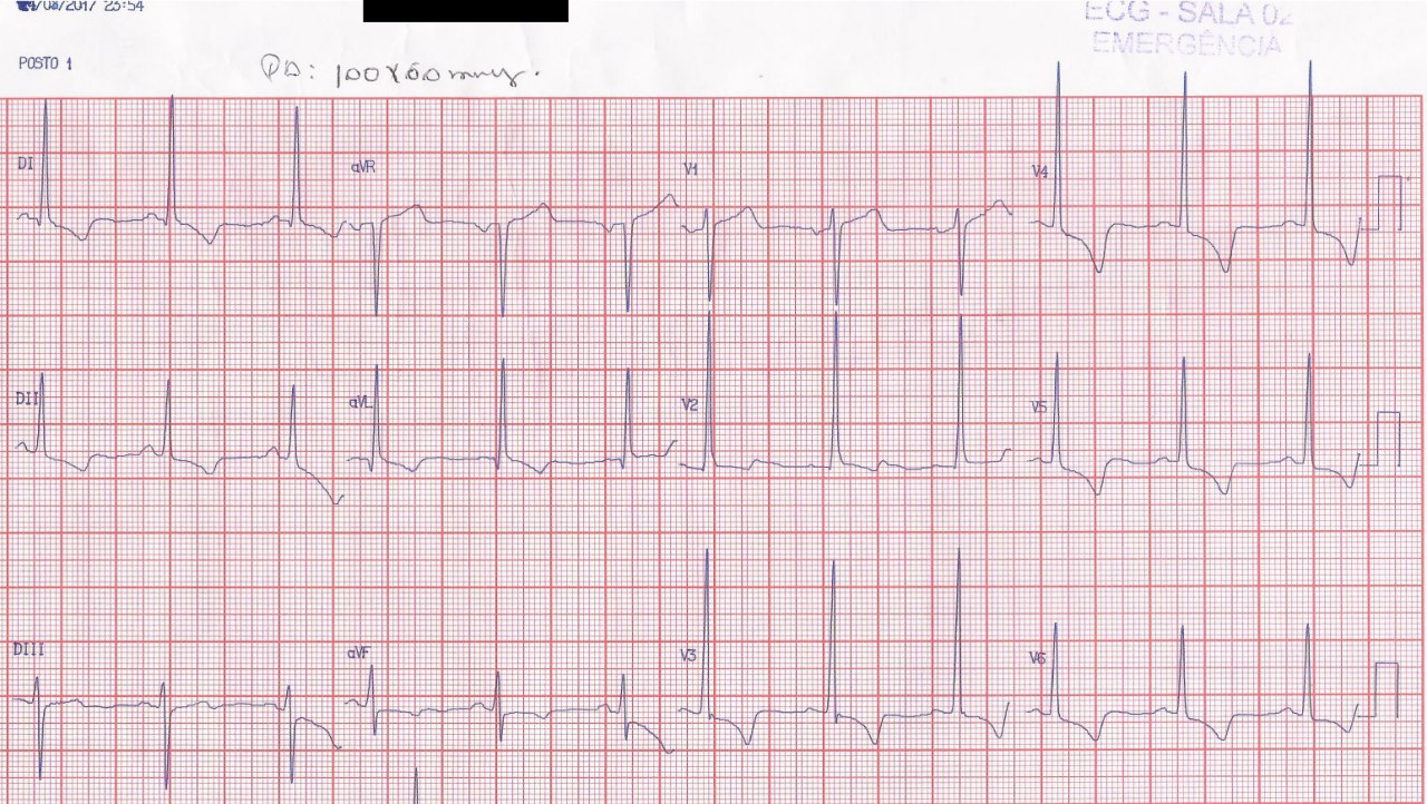 Hombre de 77 años con antecedente de disnea de esfuerzo, presencia de Fuerzas Anteriores Prominentes y ecocardiograma típico debido a una miocardiopatía hipertrófica obstructiva