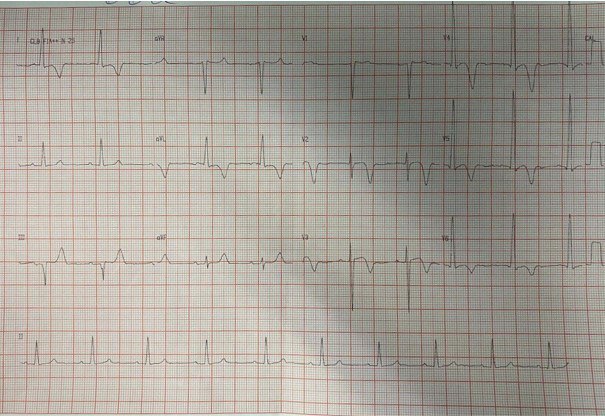 Hombre de 66 años con mareos y síncope con episodios de TVNS en el Holter que presenta una miocardiopatía hipertrófica apical obstructiva
