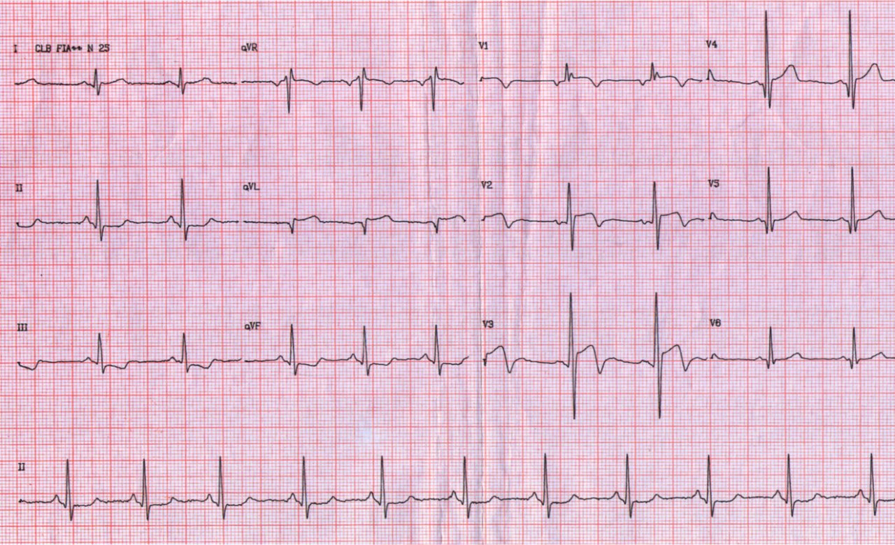 Paciente masculino de 20 años con antecedentes previos de dos episodios sincopales post esfuerzo precedidos por palpitaciones cuyo ECG muestra R altas en V1 V2 por ser portador de miocardiopatía hipertrófica