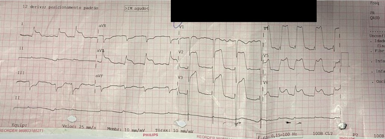 Hombre de 54 años con ángor e inestabilidad hemodinámica (shock cardiogénico) por disección del TCI con extensión distal hacia DA y Cx con flujo TIMI 0
