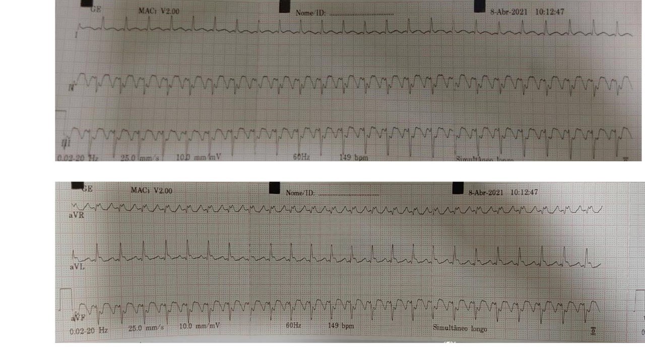 Hombre hipertenso, asintomático que en ECG de rutina presenta AA 2:1 con indicación de ARF de istmo cavo tricuspideo