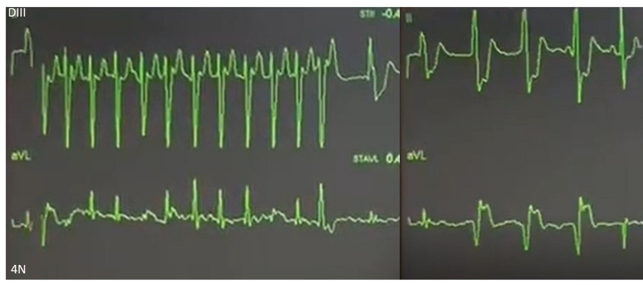 Masculino de 40 años que presenta taquicardia de QRS angosto por presencia de vía anómala cuyo ECG muestra depresiones difusas significativas del ST y elevación del mismo en las derivaciones aVR y V1, con troponina y CCG normales