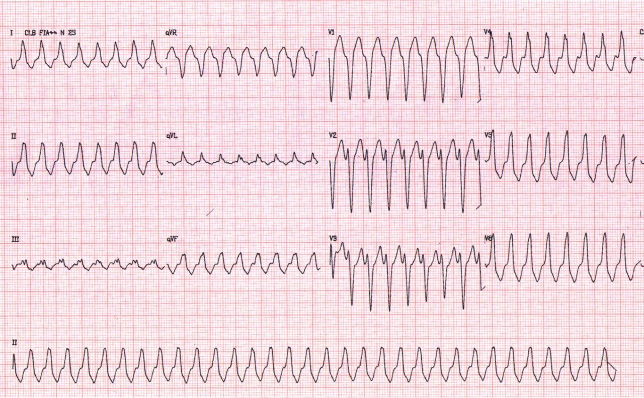 Trazado ECG que presenta una taquicardia de QRS ancho que se corresponde a una taquicardia preexcitada en un WPW