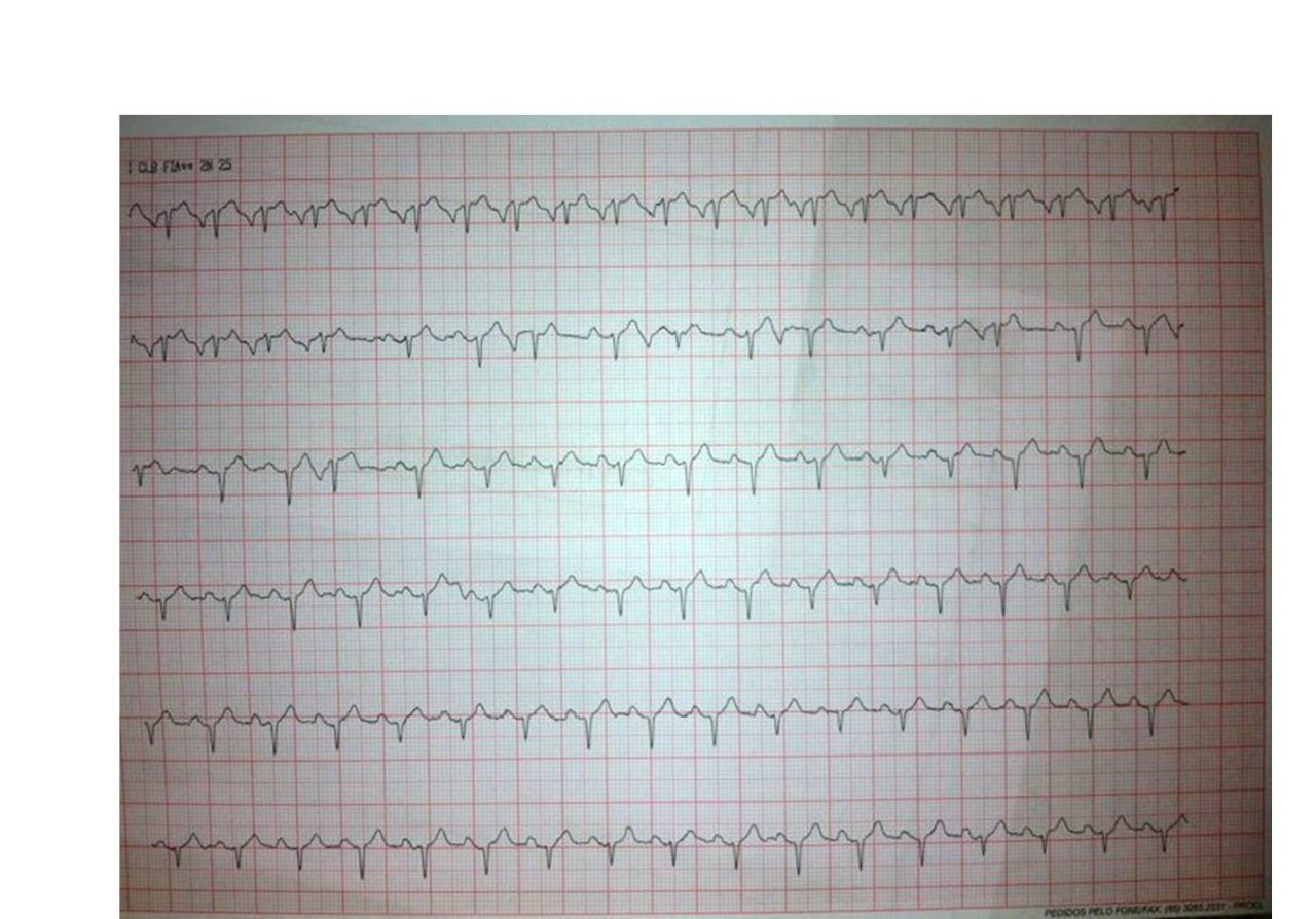 Mujer joven con diagnóstico de «miocardiopatía» con palpitaciones de larga data, que presenta una taquicardia regular de complejos QRS angostos, con un intervalo “RP” largo (RP > PR) y una onda P’ negativa en II, III y aVF, cuyo mecanismo es una reentrada