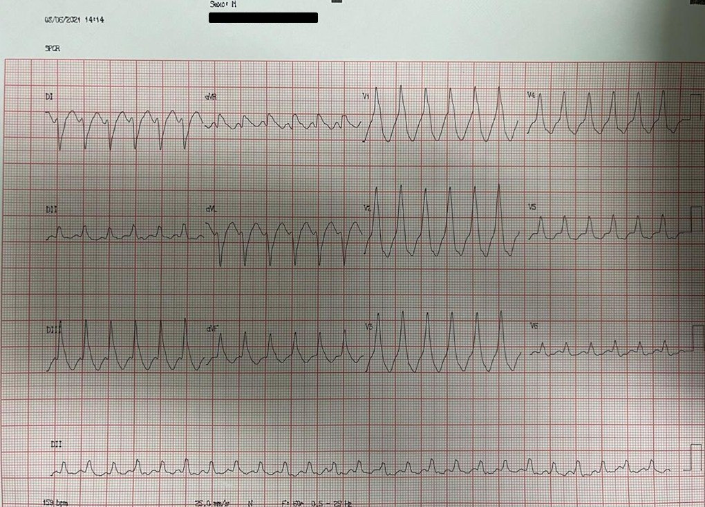 Paciente de 48 años portador de miocardiopatía chagásica (FEVI 44%), con DAI desde abril / 2021, que presenta una tormenta eléctrica originada en foco epicárdico recibiendo 20 descargas de CDI
