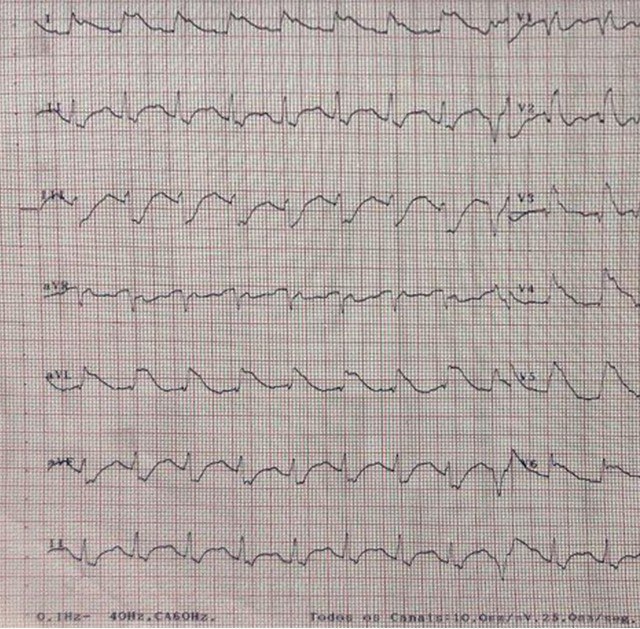 Paciente masculino, de 64 años, con síndrome coronario agudo con Elevación del segmento ST y presencia de ondas lambda por oclusión de la DA proximal